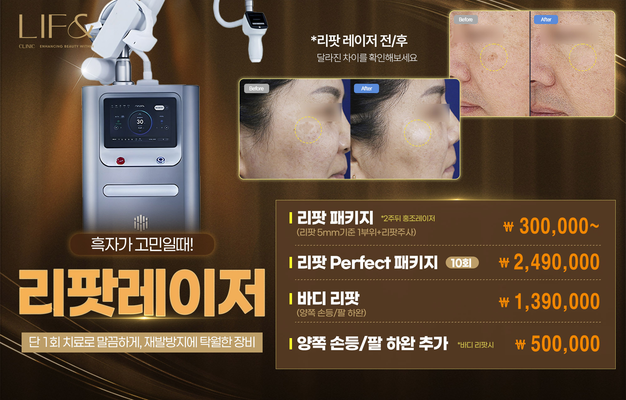 리팟레이저