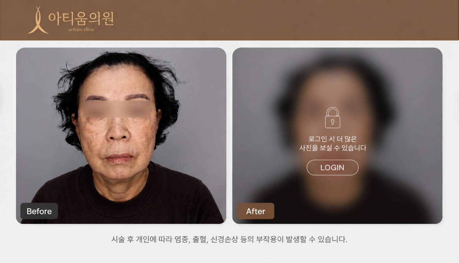 아티움의원 :: 실리프팅 + 눈밑필러