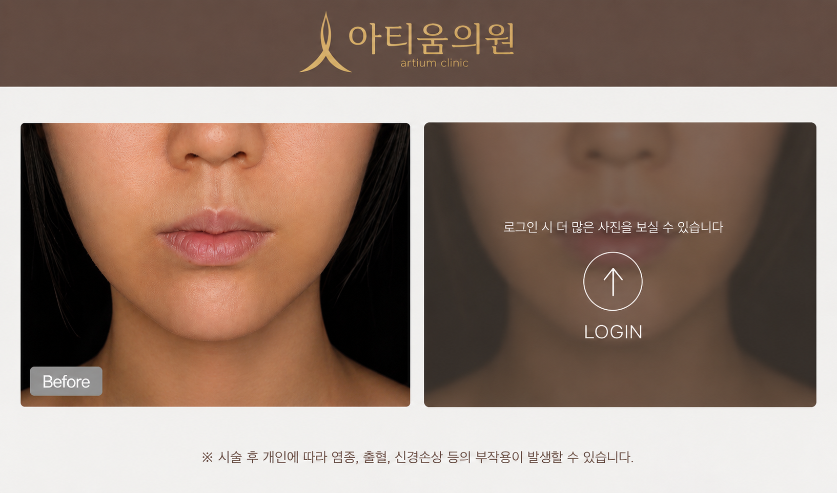아티움의원 :: 입술필러 