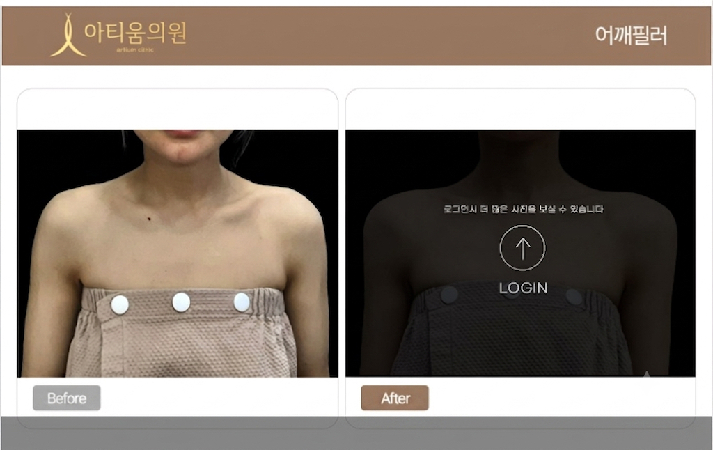 아티움의원 :: 어깨필러