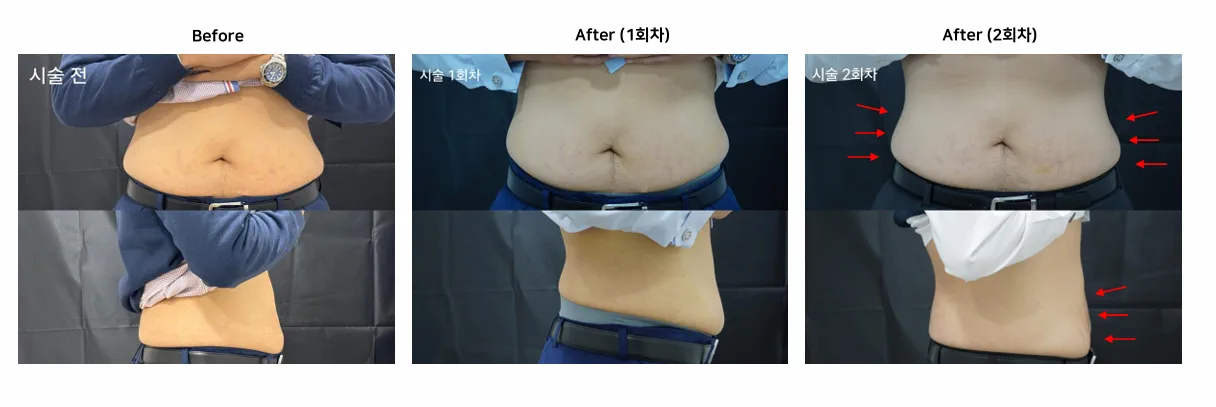 인천계양 아티뷰의원 :: 바디 파워핏 (DCA) 